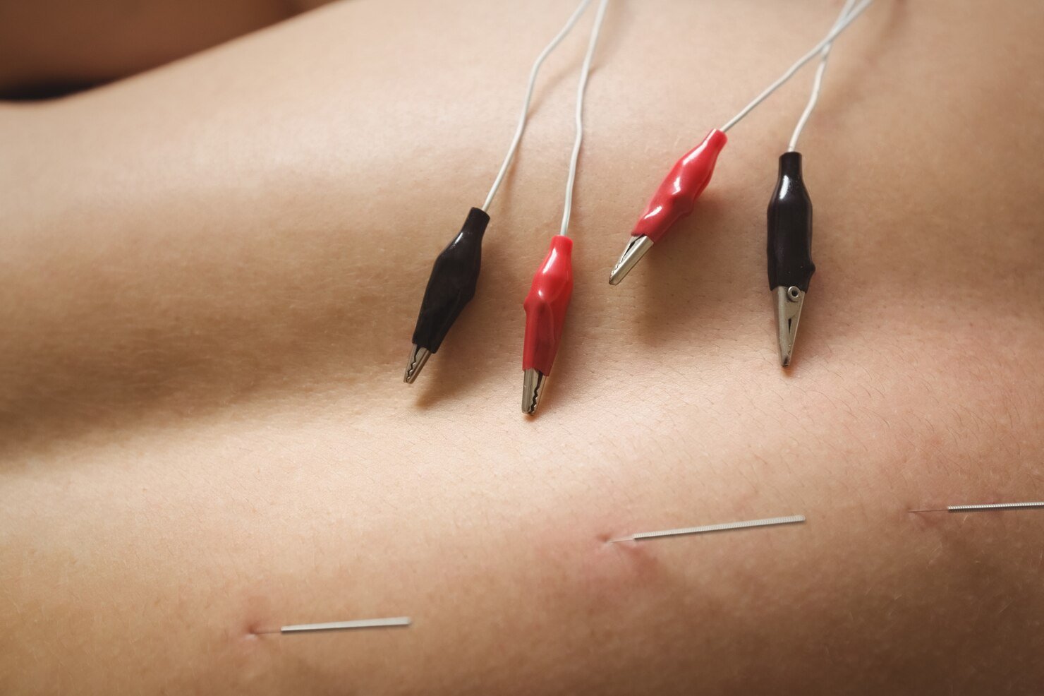 Acupuncture in Mississauga