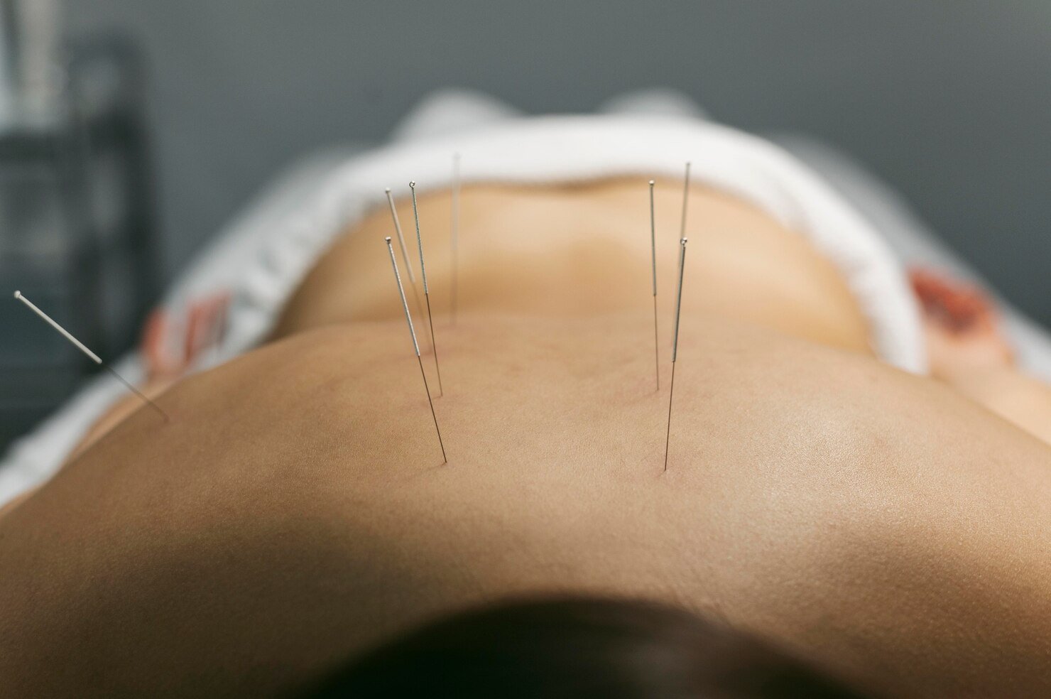 Acupuncture in Mississauga