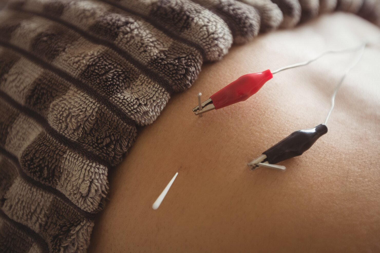 Contemporary / Western Clinical Acupuncture
